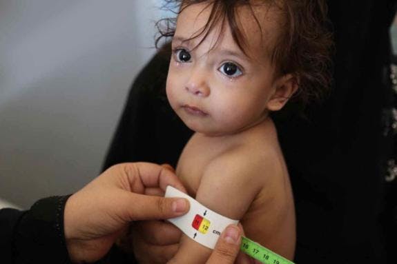 Rethink-Famine-Yemen-malnutrition-screening-575x383.jpg